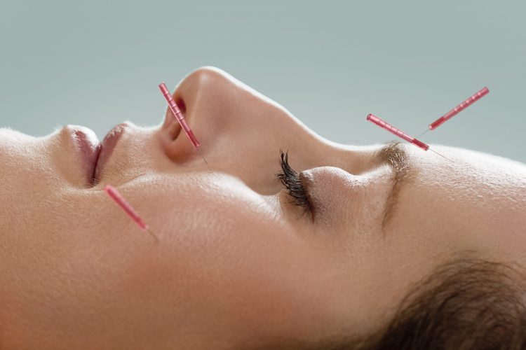 Profile of female acupuncture patient receiving facial acupuncture treatment